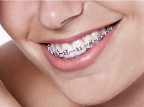 braces-incognito